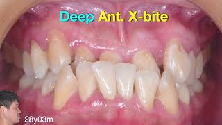 PreAligner Treatment for Class III Anterior Crossbite Correction｜【Chris Chang Ortho】CC695 [upl. by Salter]