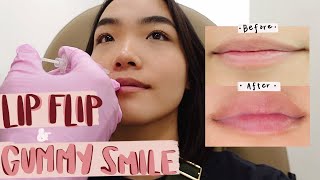 getting my lips done  lip flip  gummy smile transformation [upl. by Tobiah446]