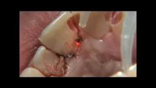 PHILIPS LASERS Eviction gingivale multiple 3wmv [upl. by Annelise]