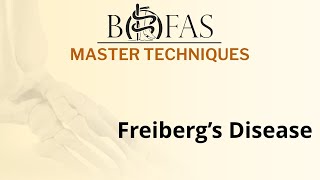 Freibergs Disease  BOFAS Master Techniques [upl. by Iden]