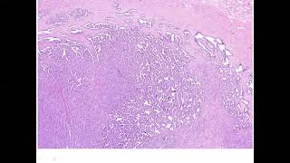 Papillary Renal Cell Carcinoma [upl. by Casavant]