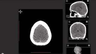 ImagingAnatomycom  CT Cerebrum  Part 1 [upl. by Elttil]