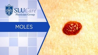 The Diagnosis and Treatment of Moles  SLUCare Dermatology [upl. by Aerdna]