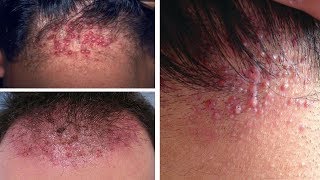 How to Treat Folliculitis on Scalp Naturally  8 Best Home Treatments for Folliculitis On Scalp [upl. by Juni767]