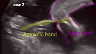 Ultrasound anomalies of fetal limbs [upl. by Papert667]