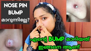 How To Get Rid Of Nose Piercing Bump FAST Home remedy for nose piercing bump [upl. by Ehcram]