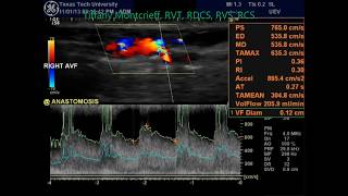 Radialcephalic Arteriovenous Fistula Duplex Evaluation AVF [upl. by Haziza782]