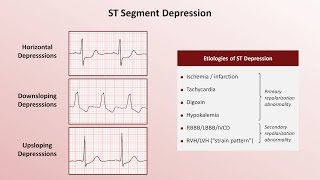 Intro to EKG Interpretation  QRST Changes [upl. by Epuladaugairam]