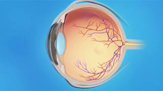 Cystoid Macular Edema Treatment  Medication Injection [upl. by O'Kelly]