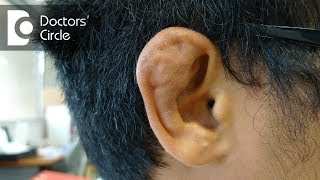 What is Cauliflower ear and its management  Dr Sreenivasa Murthy T M [upl. by Alyahc]