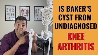 Why Undiagnosed Knee Arthritis Is To Blame For Your Painful Bakers Cyst [upl. by Lauber13]