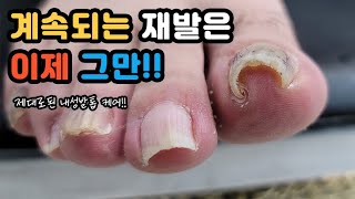 해결하기 어려웠던 내성발톱 드디어 뽑다 Ingrown toenail [upl. by Oigaib44]