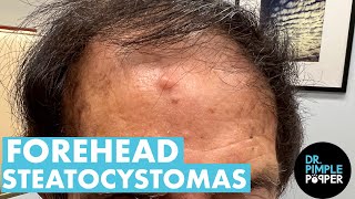 WHAT IS ON YOUR FOREHEAD Dr Pimple Popper Extracts Steatocystomas  Part 1 [upl. by Hernandez479]