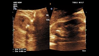 Removal of kidney stones URS [upl. by Atrim224]