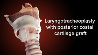 Medical Animation Posterior Cricoid Split  Cincinnati Childrens [upl. by Ettereve]