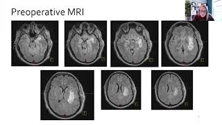 Approach to Focal Epilepsy Secondary to Dominant Temporal Low Grade Gliomas [upl. by Ariaec]