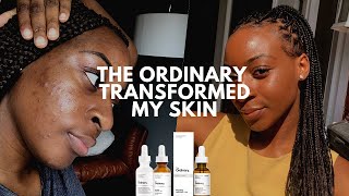 The Ordinary Skin Transformation Mandelic Acid Cleared My Acne  xoreni [upl. by Jania867]