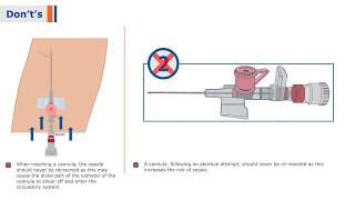 BD Venflon I  IV Cannula with BD Instaflash Needle Technology [upl. by Airolg]