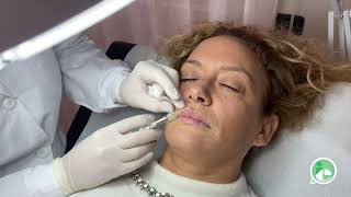 Dimostrazione Filler Labbra  drssa Francesca Palumbo [upl. by Aruasi]