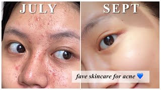 Rekomendasi Skincare utk Jerawat kombinasi berminyak [upl. by Harold]