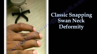 Swan Neck Deformity Classic Snapping  Everything You Need To Know  Dr Nabil Ebraheim [upl. by Aciretnahs298]