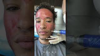 Microneedling with PRP for Acne Scars  Kami Parsa MD skincare acnescars [upl. by Malena]