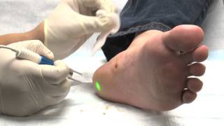 Laser treatment for Warts using the FOX Laser [upl. by Dorelle830]