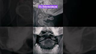 Os Odontoideum shorts radiology xray anatomy [upl. by Weiner]