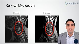 Cervical Myelopathy  What is it How can we treat it [upl. by Hinson]