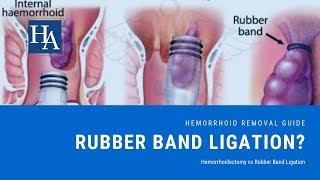 Hemorrhoidectomy vs Rubber Band Ligation Reviews  Recovery Time Cost and Effectiveness [upl. by Natsirt]