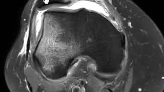 Transient patellar dislocation of knee [upl. by Larret105]