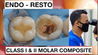 Step by Step Layering Composite Class II Lower Molar Endo  Resto  General Dentist Griya RR [upl. by Aivatnohs82]