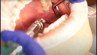 Inferior Alveolar Nerve Block Demonstration and Overview 4K [upl. by Eelinej]