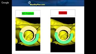 Creating Custom Surgical Guides Everything Blue Sky Plan  Part 5 [upl. by Fiorenze]