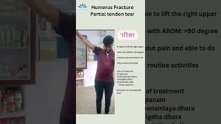 Ligament tear Patient testimonial DrLRakesh MD Panchakarma [upl. by Landri219]