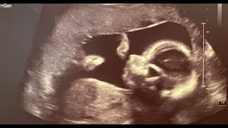 Anomaly Scan Full Video  Full Anatomy Scan at 21 Weeks [upl. by Yonatan]