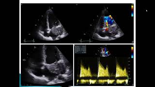 Intracardiac Masses Case 2 [upl. by Aldredge552]