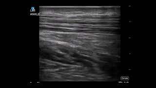 Ankle Ultrasound Achilles Tendonitis With Enthesophyte [upl. by Atrebor259]