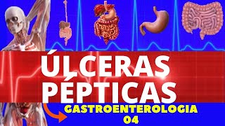 ÚLCERAS PÉPTICAS CAUSAS SINTOMAS DIAGNÓSTICO E TRATAMENTO  GASTROENTEROLOGIA [upl. by Akcired]