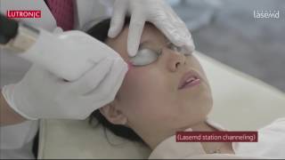 Lasemd Treatment and procedure video clip [upl. by Obediah758]