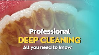 3 steps for a deep scaling and professional teeth cleaning [upl. by Litman731]