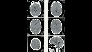 Acute Withdrawal vs PAWS  PostAcute Withdrawal Syndrome [upl. by Edette]