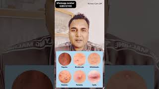 Acne and pimples Best Homeopathic Treatment Black and White Heads चेहरे पर मुंहासे से छुटकारा [upl. by Haidabo928]