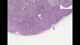 Histopathology Lymph node Follicular hyperplasia [upl. by Reinhardt]