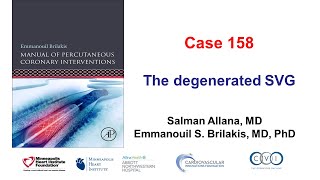 Case 158 Manual of PCI The degenerated SVG [upl. by Ettezzil]