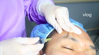 eng sub Acne Scar Treatment  RF Microneedling  TCA Cross  Subcision  5th Session  Philippines [upl. by Tania]