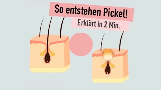 So entstehen Pickel  erklärt in 2 Minuten  WOMANSKILLS [upl. by Oirom]