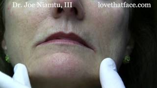 Botox Injection to DAO corner of mouth by Dr Joe Niamtu III [upl. by Reivad]