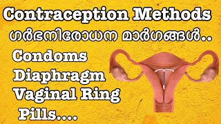 ഗർഭനിരോധന മാർഗങ്ങൾ  Contraception Methods  Copper T  Malayalam [upl. by Gertrudis]