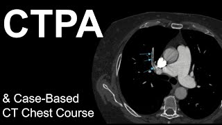 CT Pulmonary Angiogram Pulmonary Embolism CaseBased Course [upl. by Poll]